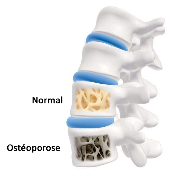 osteoporose