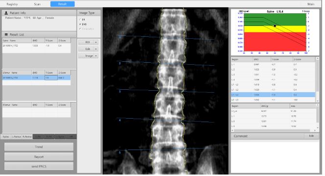 ostéo densitométre DEXA 15