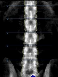 ostéo densitométre DEXA 3