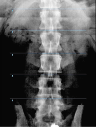 ostéo densitométre DEXA 4